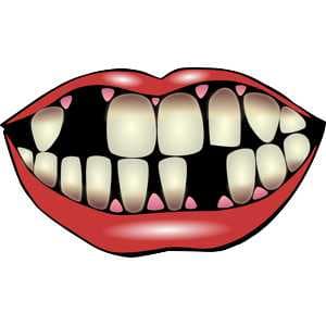 Fehlende Zähne