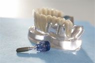 Zahn + Implantat