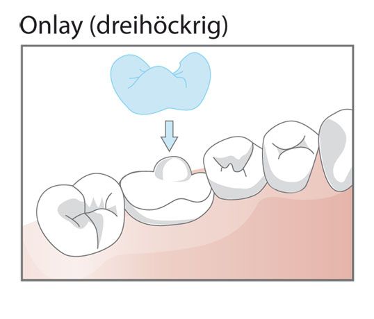 Was Sind Inlays Und Onlays.html