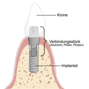 11prof dhom implantologie team ludwigshafen partner zahnimplantate