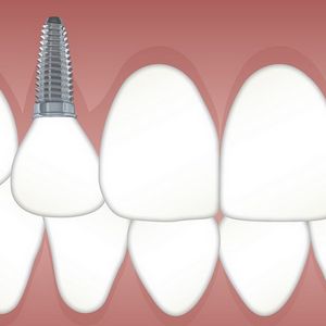 Zahnimplantat Haltbarkeit